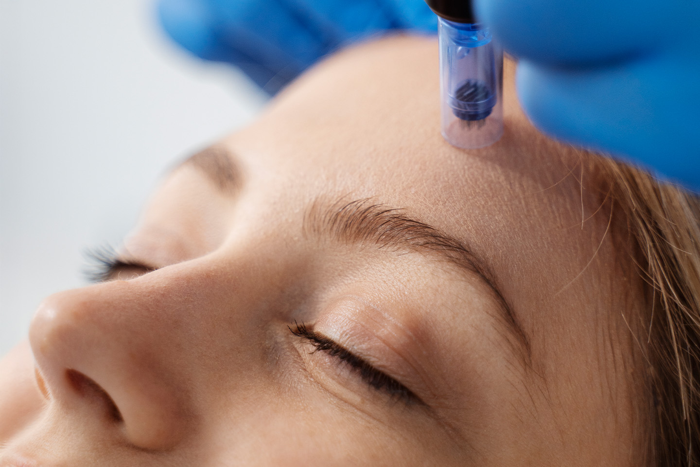 Hudföryngring PRX-T33 med/utan microneedling på Kungsholmen