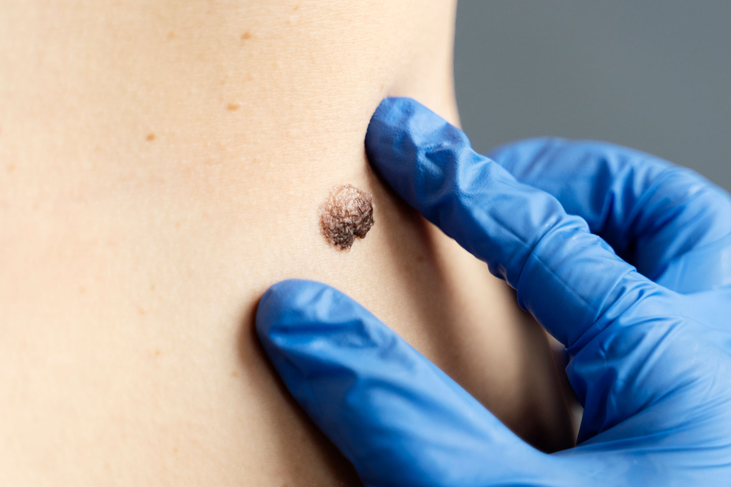 Borttagning av leverfläckar & pigmentfläckar i Sollentuna