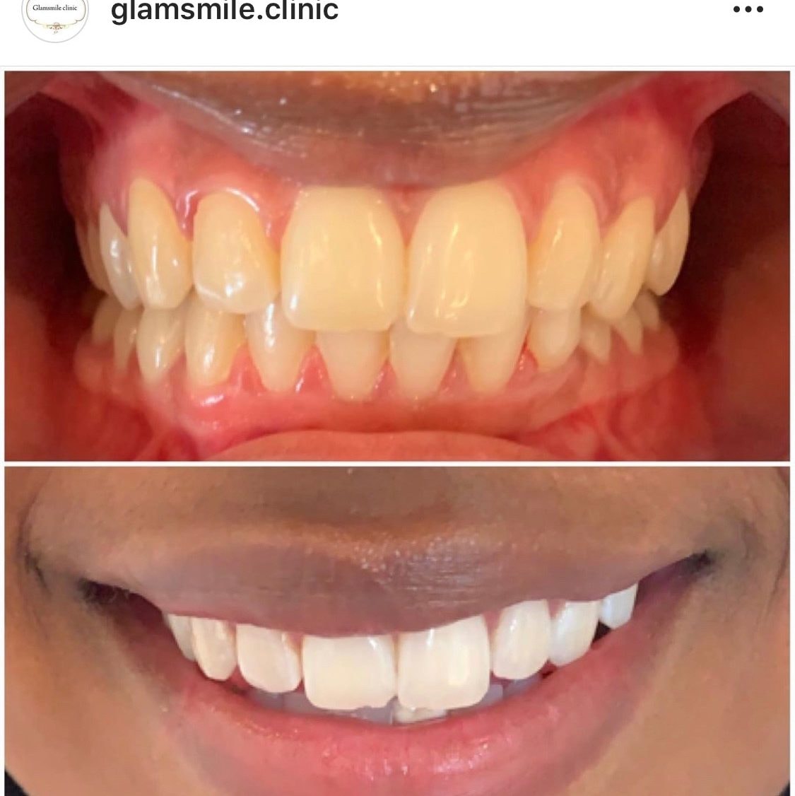 Glam Smiles tandblekning för hemmabruk (1 av 4)