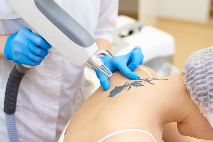 Tatueringsborttagning med laser på Östermalm
