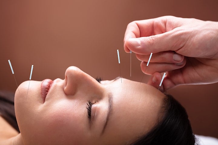 Ansiktslyft med Taoistisk akupunktur hos Unikvård