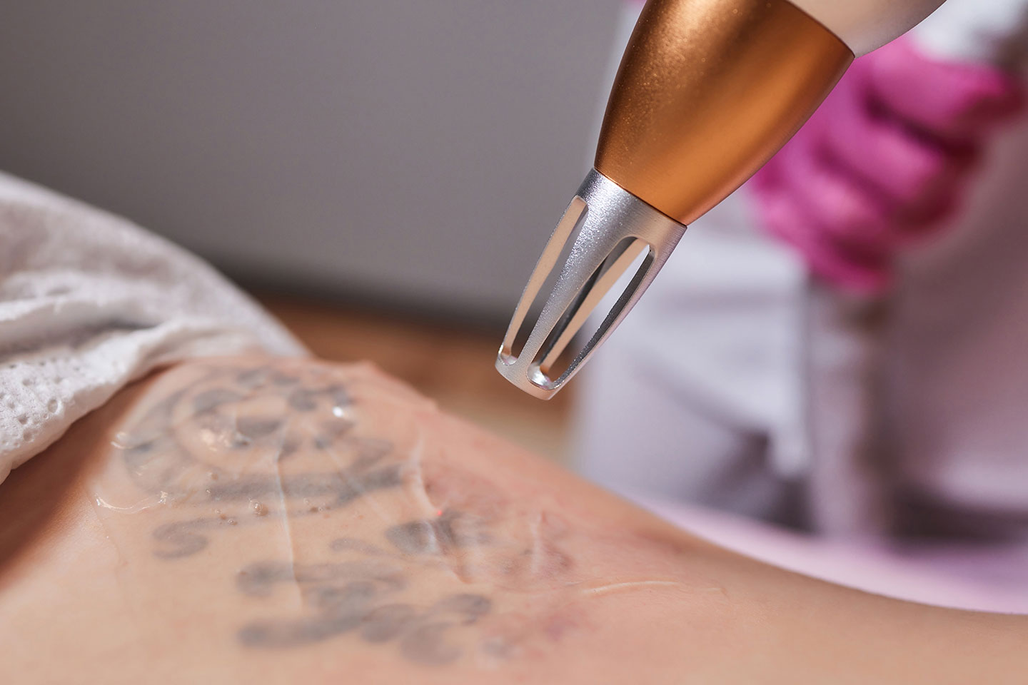 Ta bort tatuering med YAG-laser i Olskroken