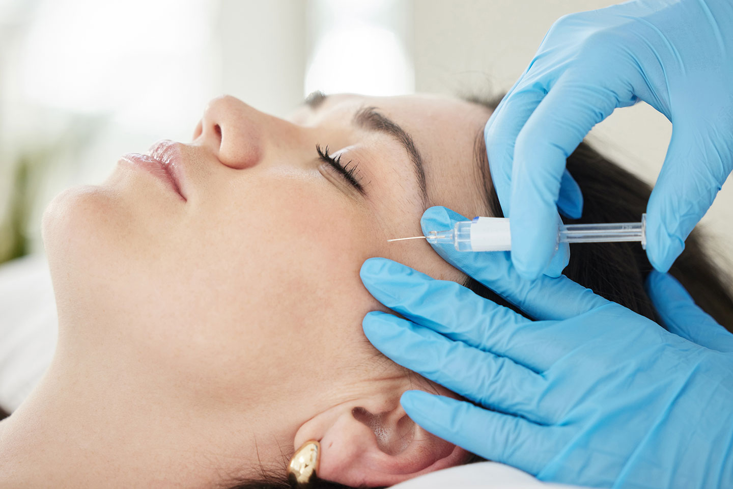 Fillers med Radiesse 1,5 ml vid Rambergsvallen