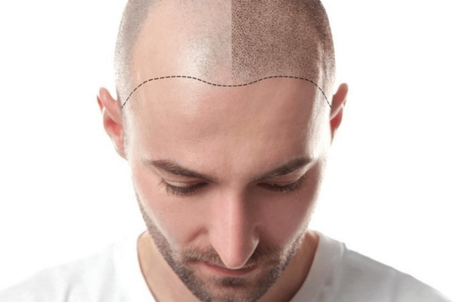 SMP mot håravfall 3 behandlingar (1 av 2)