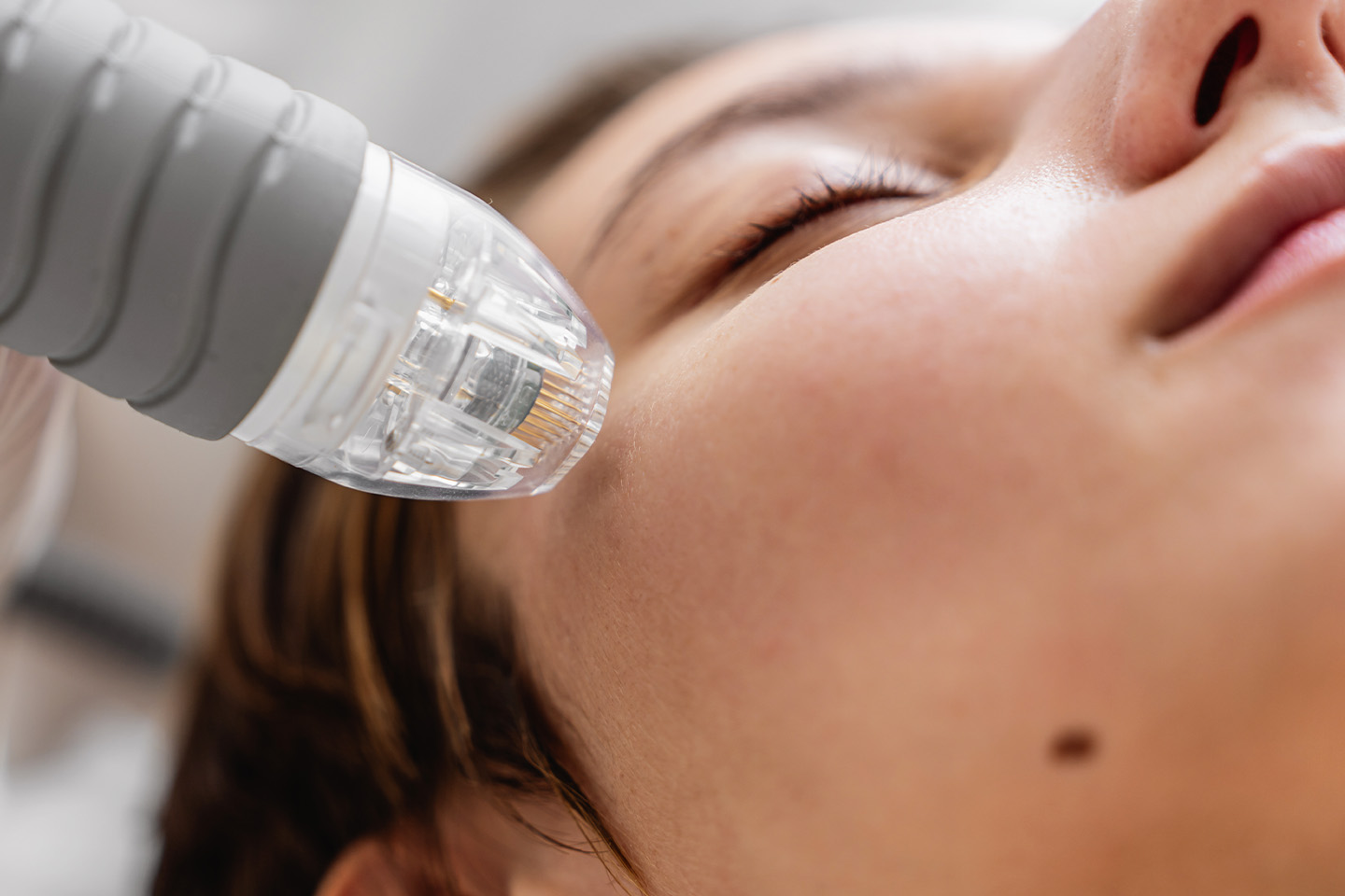 RF Microneedling hudföryngring hos Newshape Clinic på Kungshomen