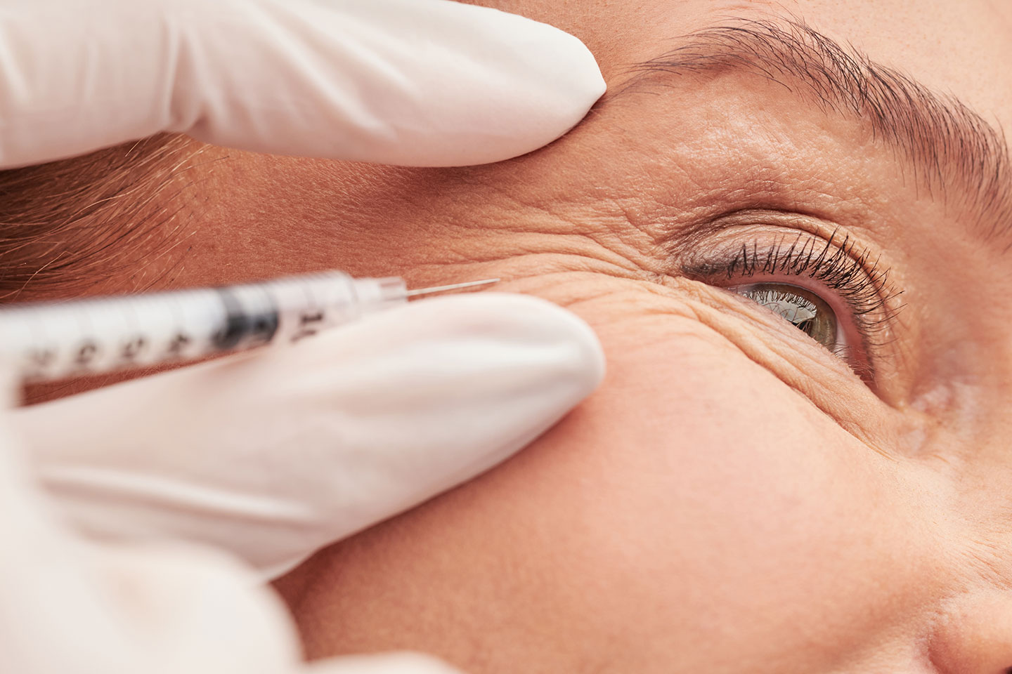 Medicinsk injektion 1-3 områden hos UPerfection i Hammarby sjöstad