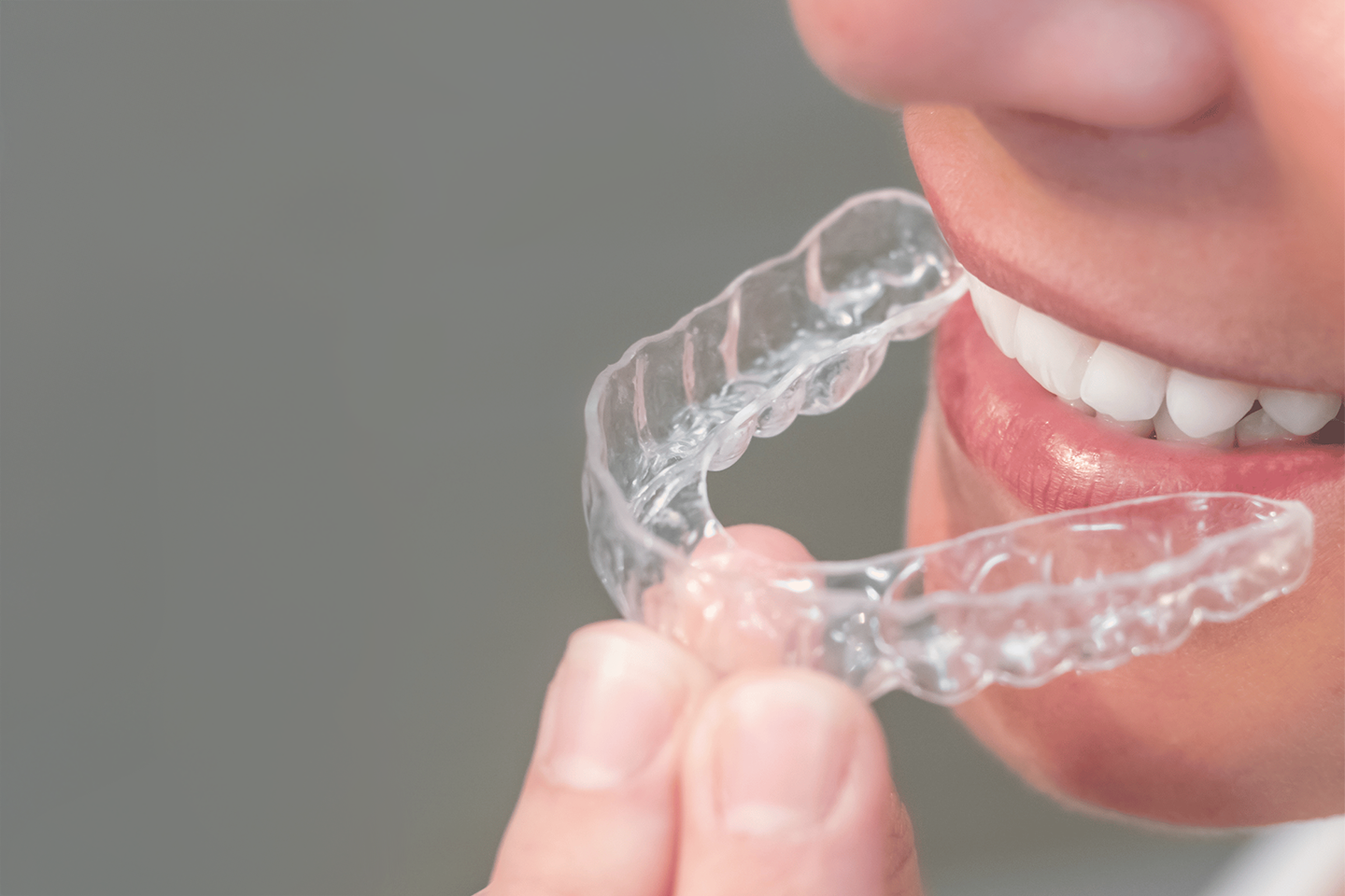 Osynlig tandställning Invisalign hos West Dental i Malmö