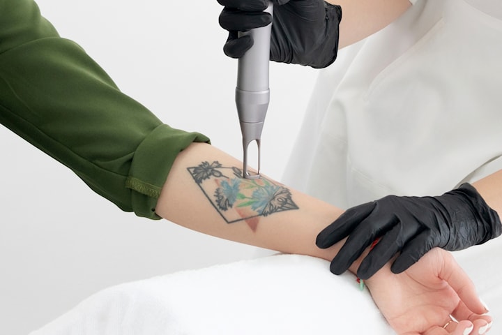 Tatueringsborttagning med laser