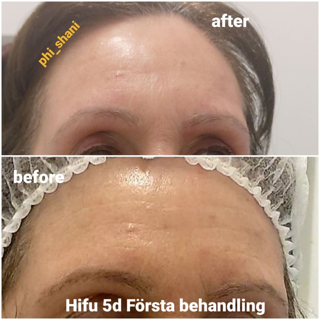 HIFU 3D/4D/5D för ansiktslyft/huduppstramning och fettreducering (4 av 5)