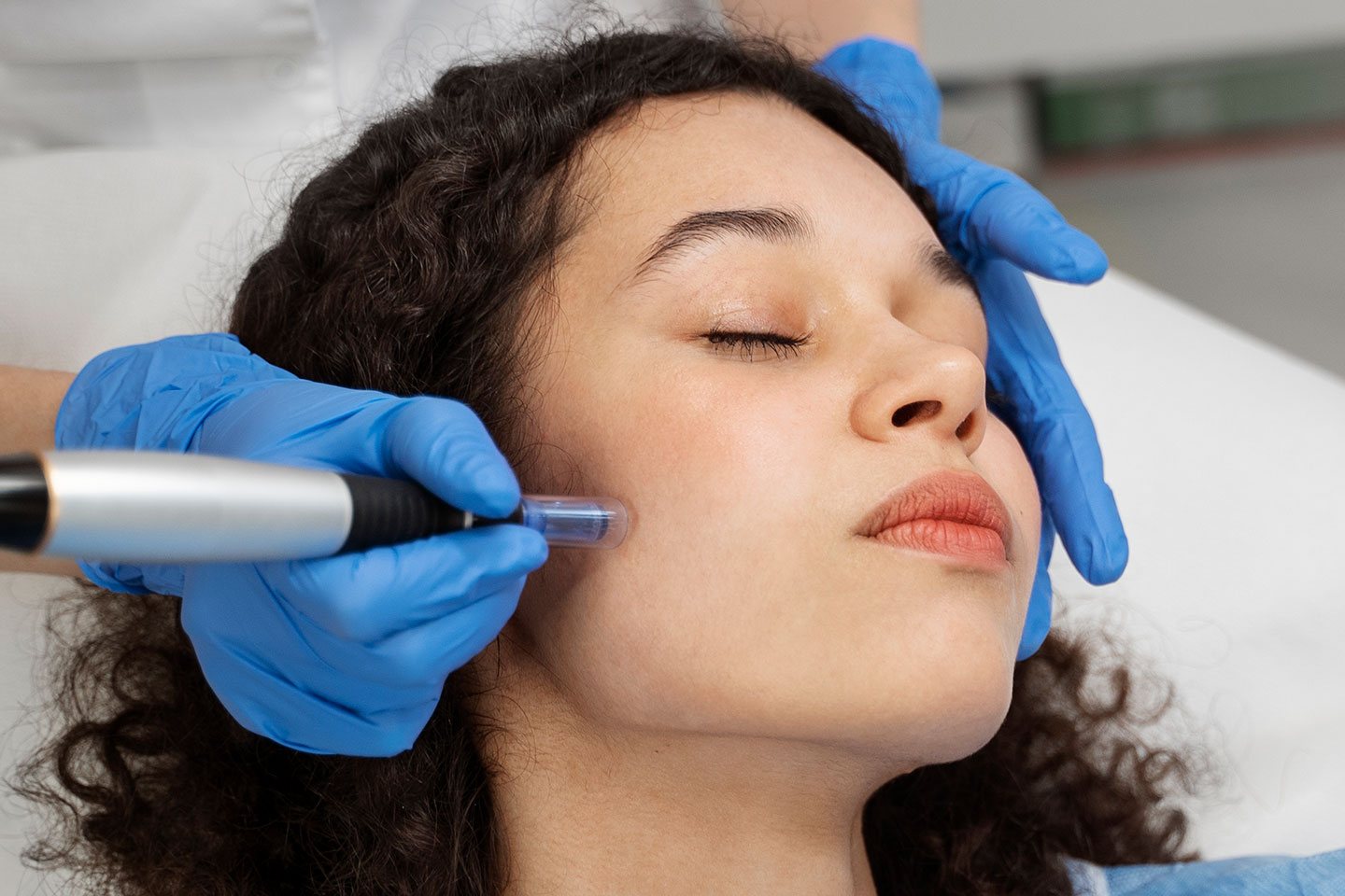PRF eller microneedling med Lax-DNA i Majorna