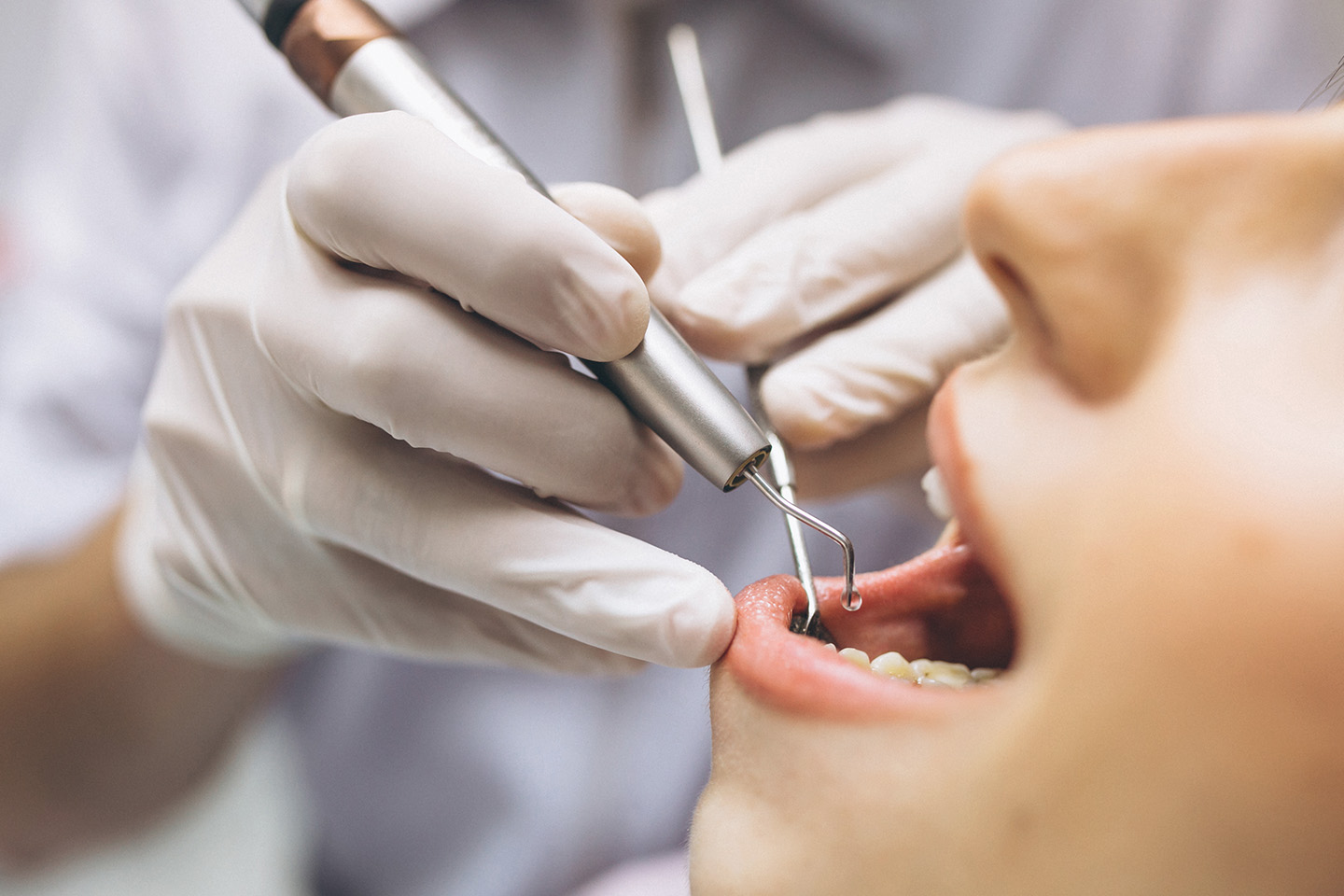 Tandläkarundersökning och lagning av 1 tand hos Frölunda Tandvård