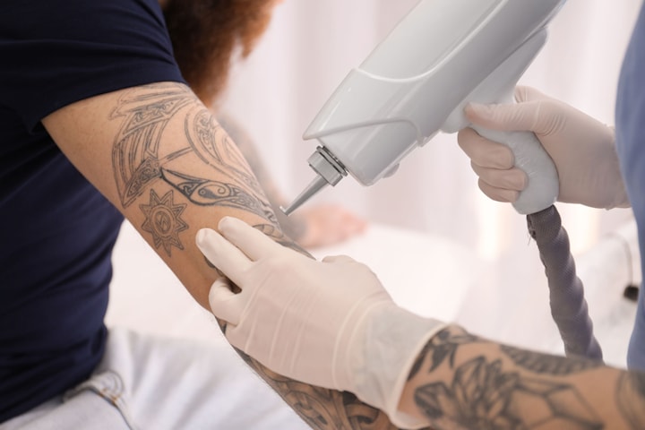 Tatueringsborttagning med YAG-laser hos Magic Touch hudvård i Lund
