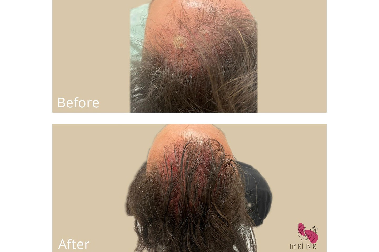PRP-behandling mot håravfall hos DY.M Klinik AB vid Chalmersgatan (1 av 3) (2 av 3)