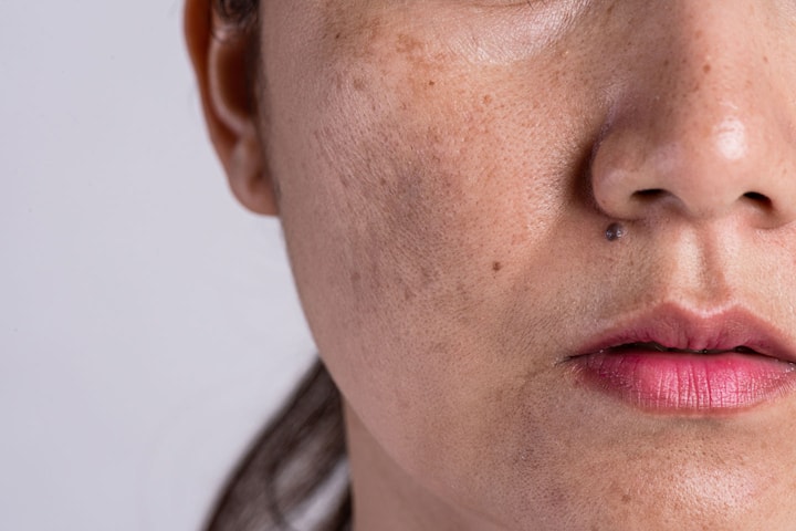 Behandla ytliga blodkärl, vårtor eller födelsemärken i ansiktet