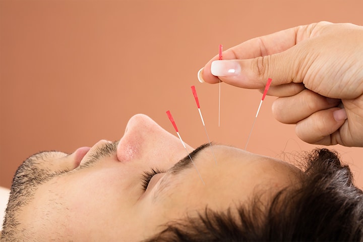 Akupunktur nesttun