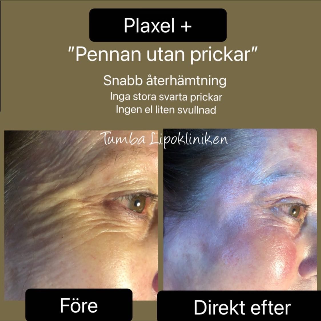 Huduppstramning med plasma pen Plaxel Plus hos Tumba Lipokliniken (1 av 7)