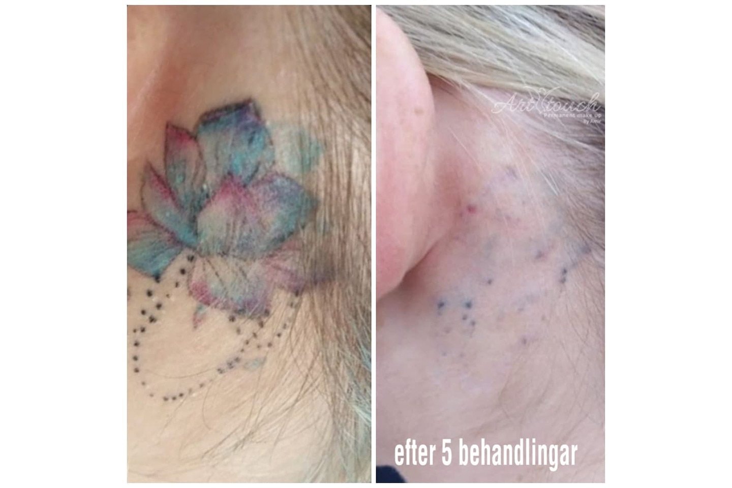 Tatueringsborttagning med laser, upp till 3 behandlingar (4 av 5)