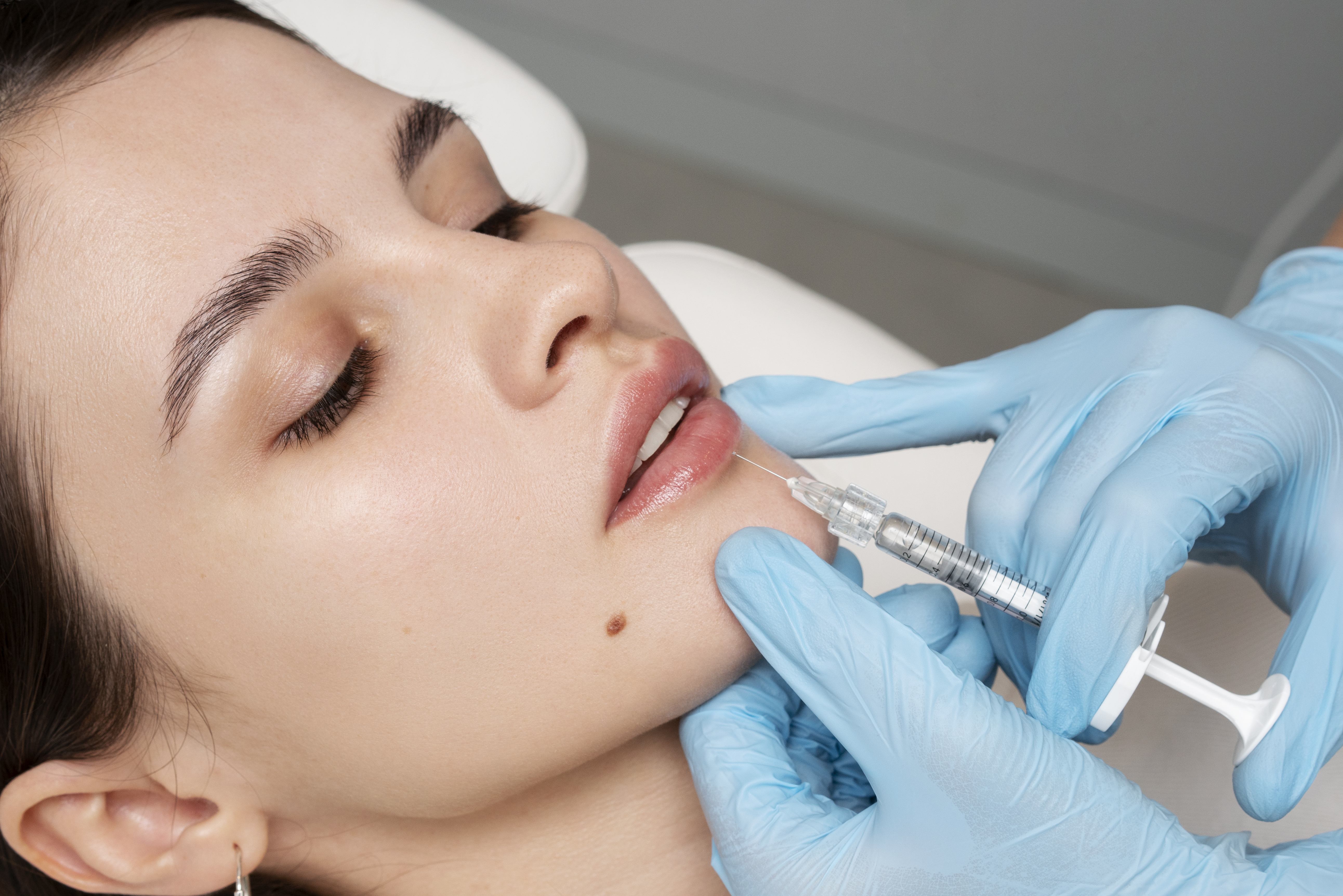 1 ml filler av valfritt område hos NurseLab i Majorna
