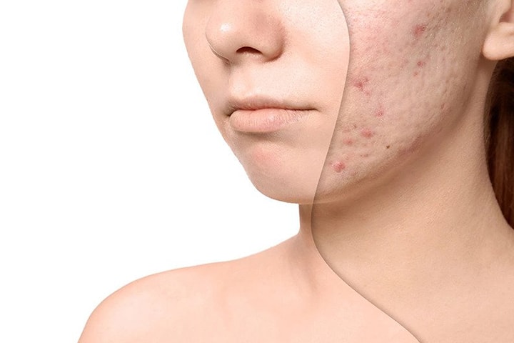 Effektiv behandling mot acne hos CM Beauty (2 av 4)