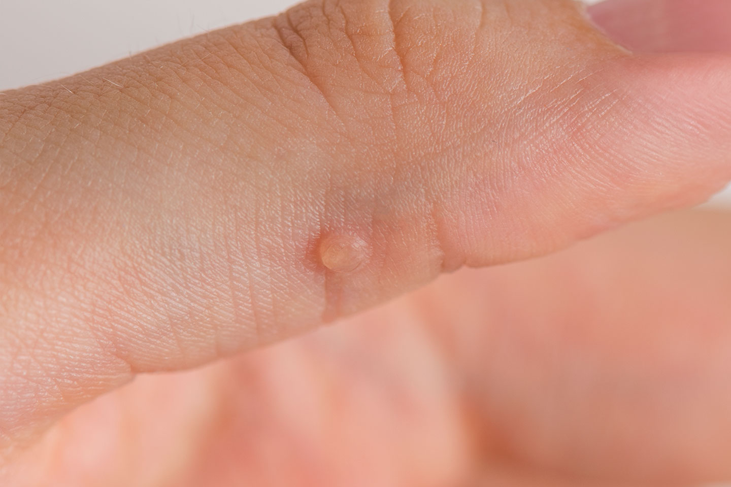 Vårtbehandling för händer och fötter upp till 10 st vid Västra Hamnen