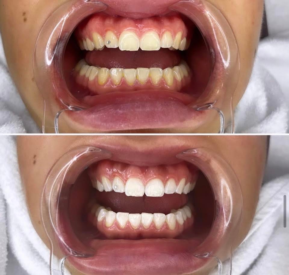 Tandblekning - upp till 9 nyanser vitare efter 1 behandling (1 av 4) (2 av 4)