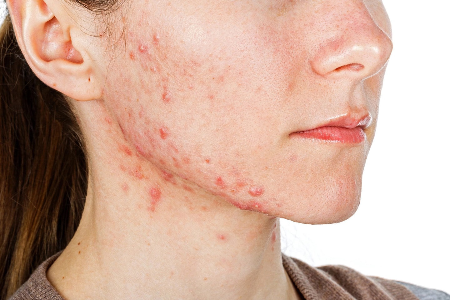 Effektiv behandling mot acne hos CM Beauty (1 av 4) (2 av 4)