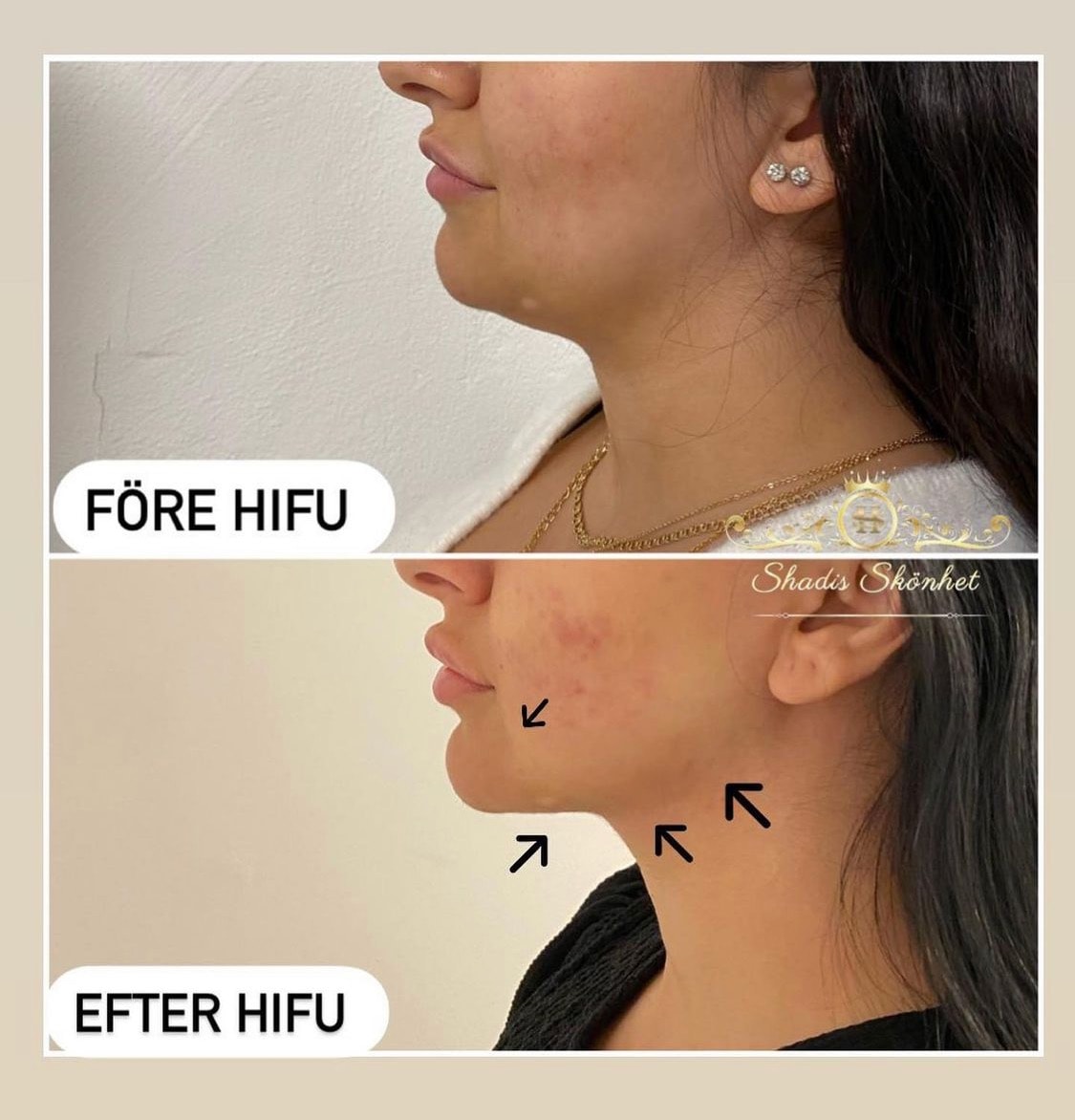 Ansiktslyft / hudåtstramning och fettreducering med HIFU 7D (4 av 14)