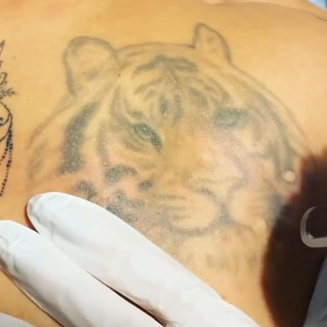 Ta bort oönskade tatueringar med Q-terra Q10 Laser hos Dottoressa Clinic (3 av 4)