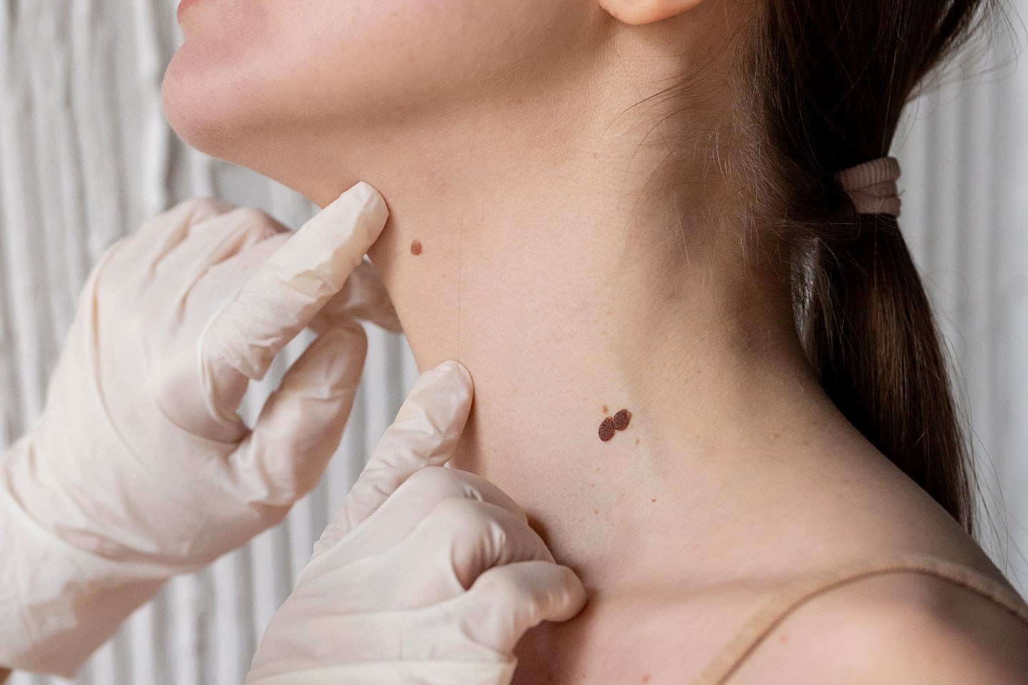 Ta bort leverfläckar upp till 5 st med Plasma Pen i Olskroken