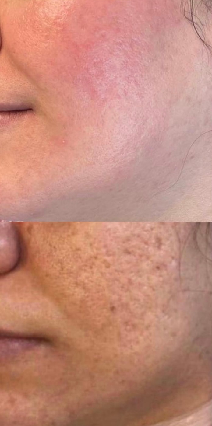 Microneedling med dermapen + lugnande och fuktgivande ansiktsmask (2 av 9)