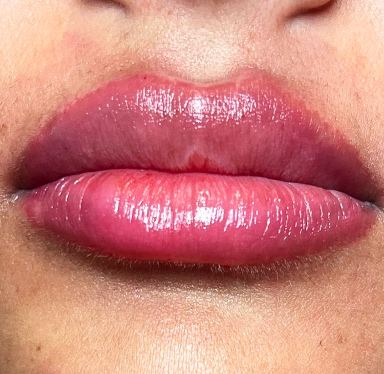 Få 1ml med Russian Flat Lips filler utført av lege hos hos Pop's Clinic ...
