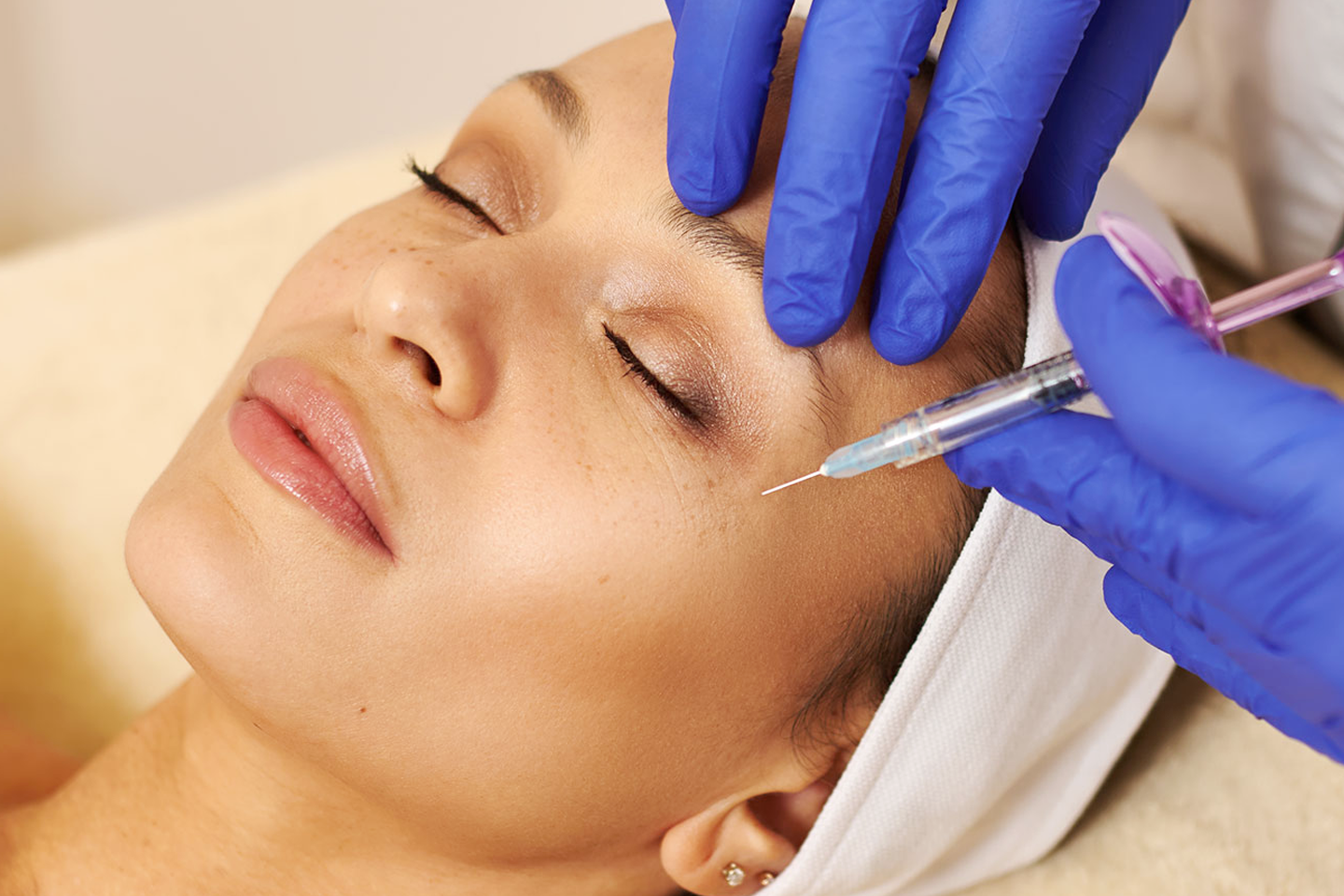 1,1 ml fillers inkl. 3 områden botulinumtoxin i Sisjön