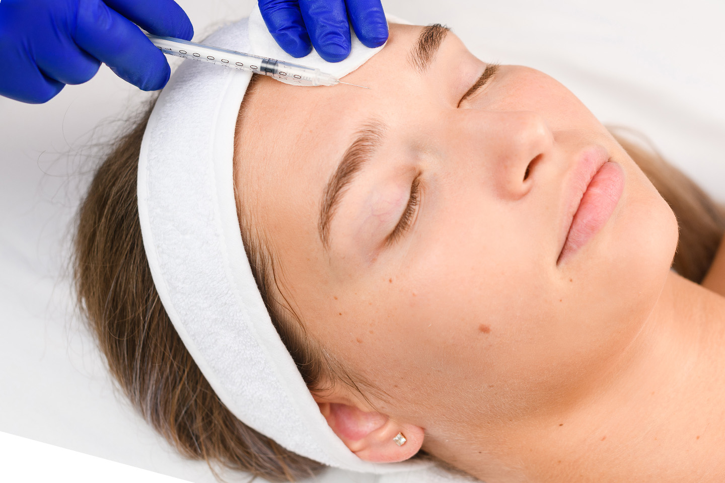 Botulinumtoxin 1-3 områden eller Mini Face Lift 3 ml i Majorna