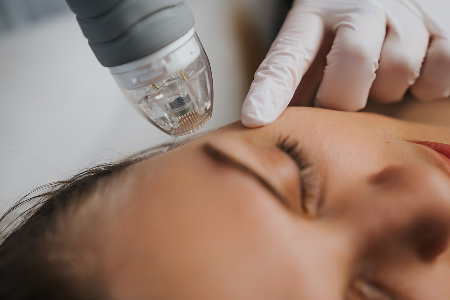 RF Microneedling hudföryngring av ansikte vid Olskrokstorget