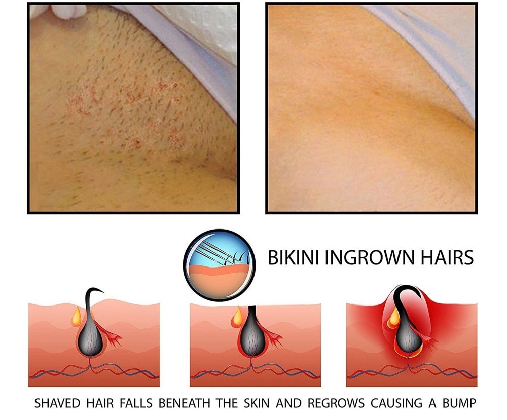 Permanent hårborttagning med laser - 4 tillfällen (3 av 4)
