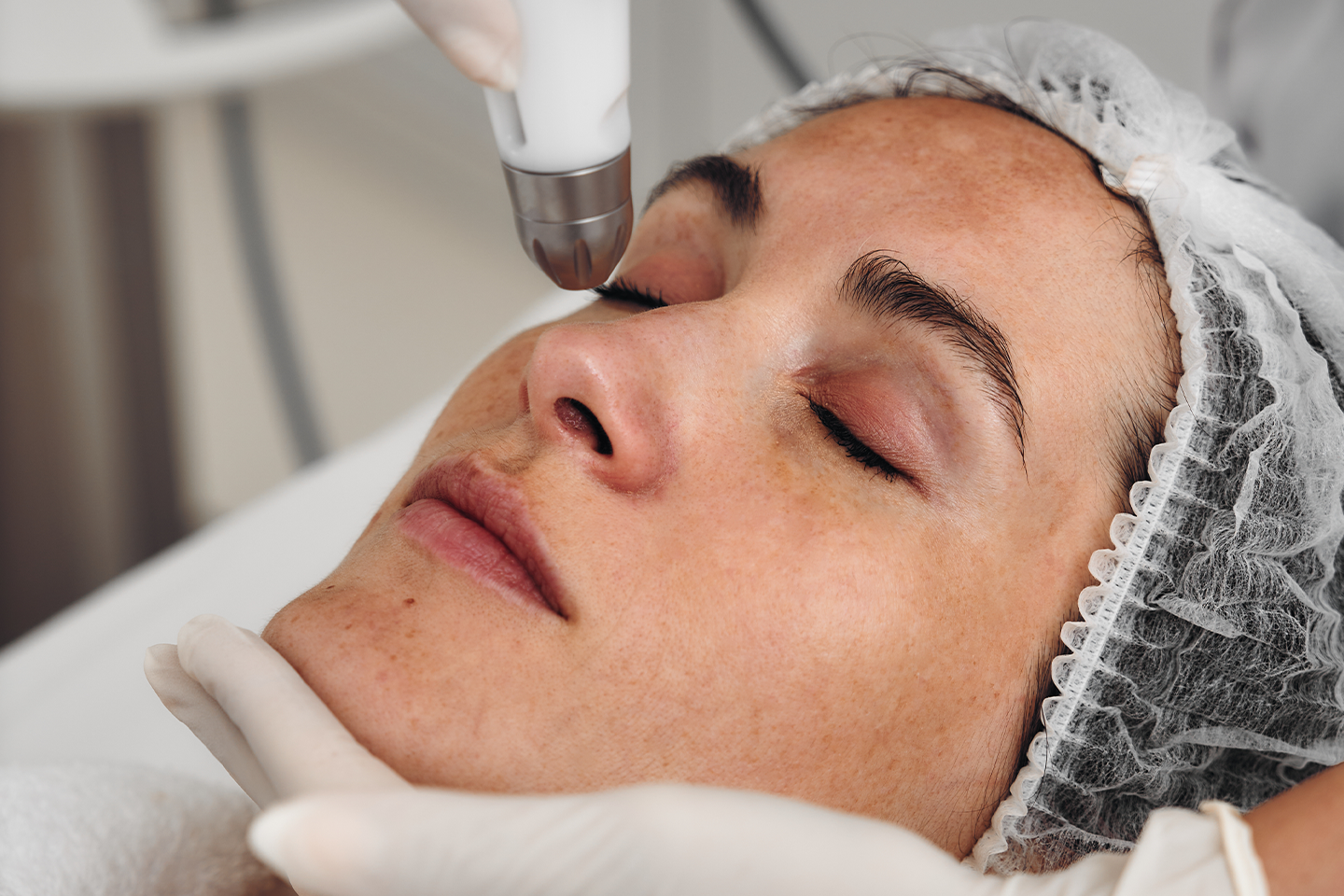 Hudföryngring med IPL hos Laserklinikcenter i Uppsala