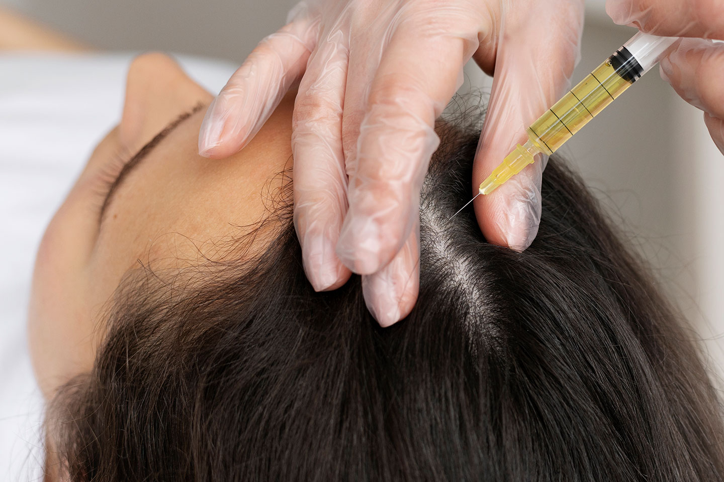 PRP-behandling mot håravfall hos La Belle i centrala Malmö