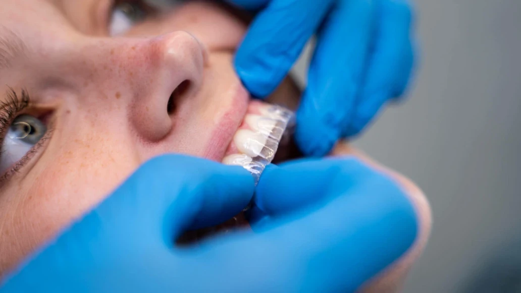 Utredning + behandlingsplanlegging for usynlig tannregulering hos Fjord Dental (6 av 7)
