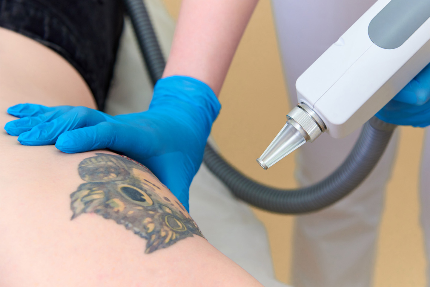 YAG-laser tatueringsborttagning hos Beauty By Dana, Sundbyberg