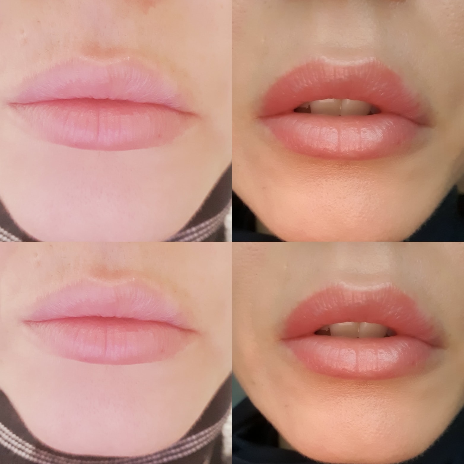 Kosmetisk läpptatuering- Lip blush (1 av 6)