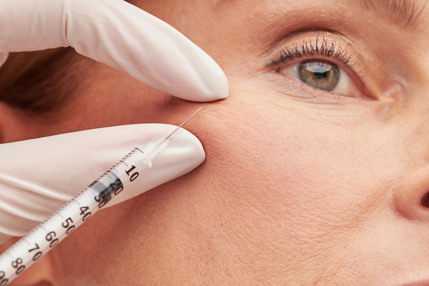 Botulinumtoxin 3 områden hos PhiArt Sweden i Järfälla