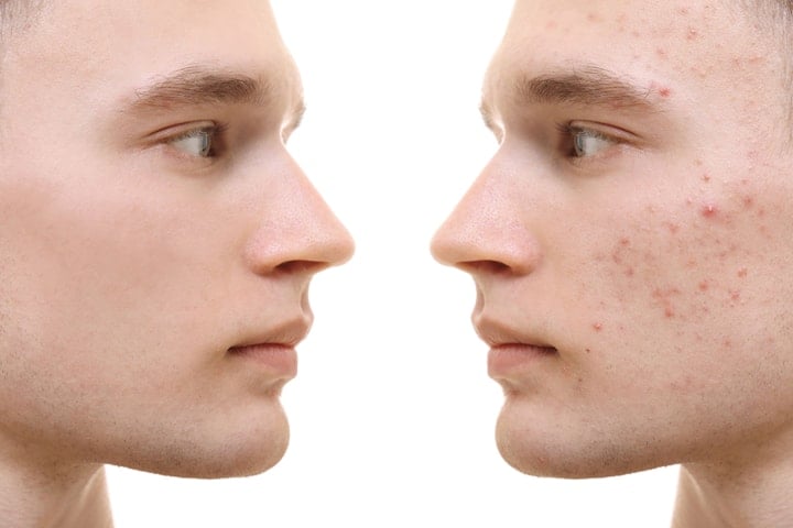 Effektiv behandling mot acne hos CM Beauty