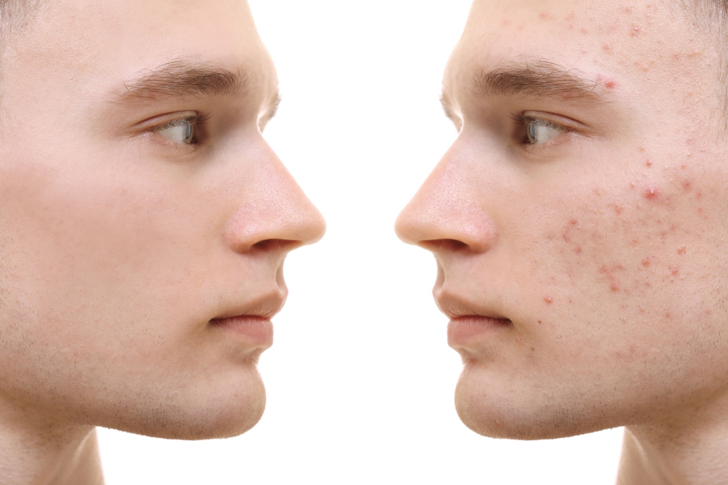 Effektiv behandling mot acne hos CM Beauty (1 av 4)