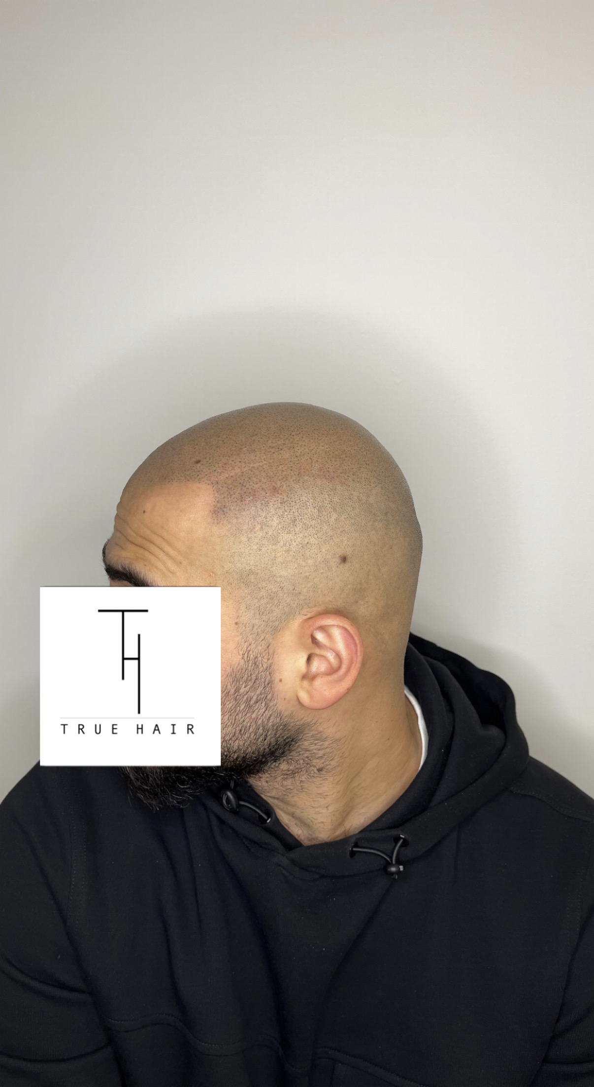 Scalp micropigmentation 1 eller 3 behandlingar hos Truehair Mölndal ...