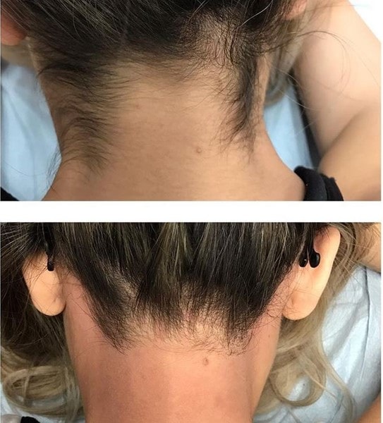 Permanent hårborttagning med alxeandritlasern hos Glamour infinite clinic (3 av 6)