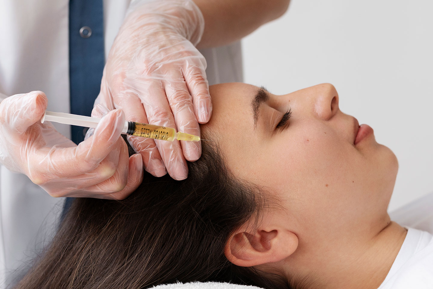 PRP-behandling för håravfall och hudföryngring 1-3 tillfällen i Vasastan