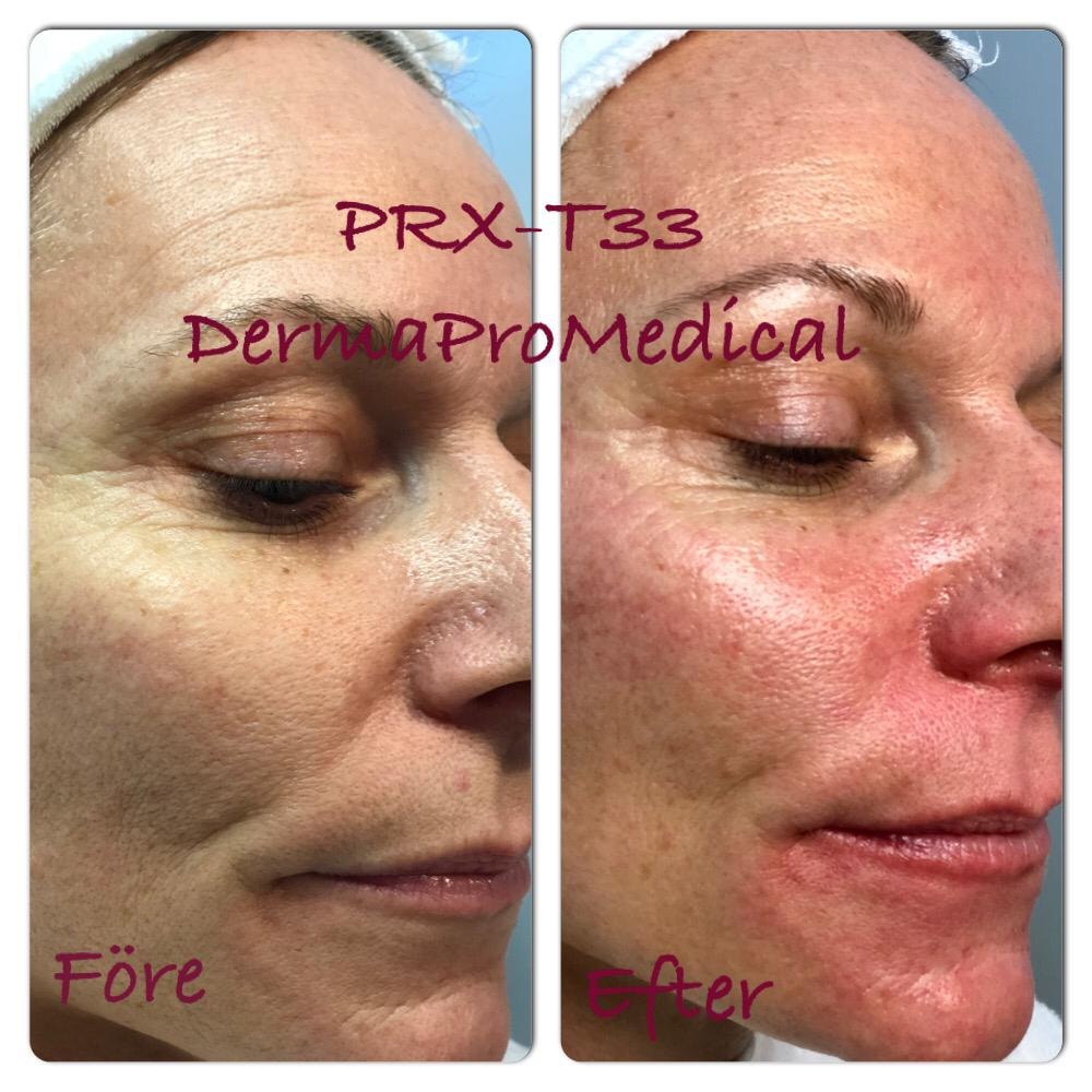 Effektiv hudföryngring utan nålar med T-PRX35® (1 av 2)