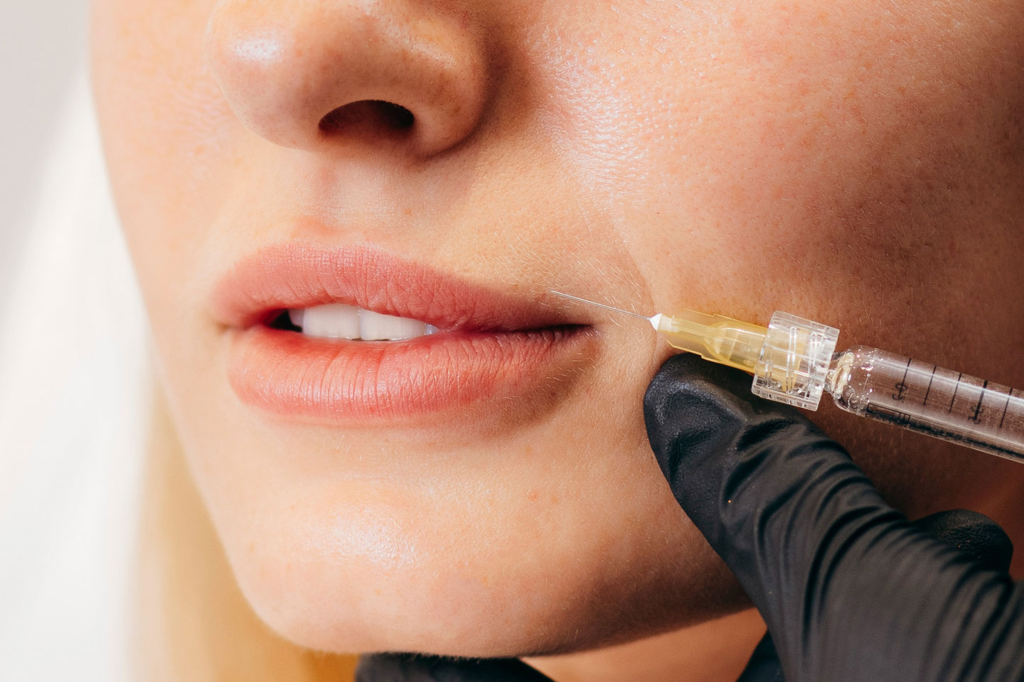 Fillers 1 eller 2 ml på valfritt område i Bromma