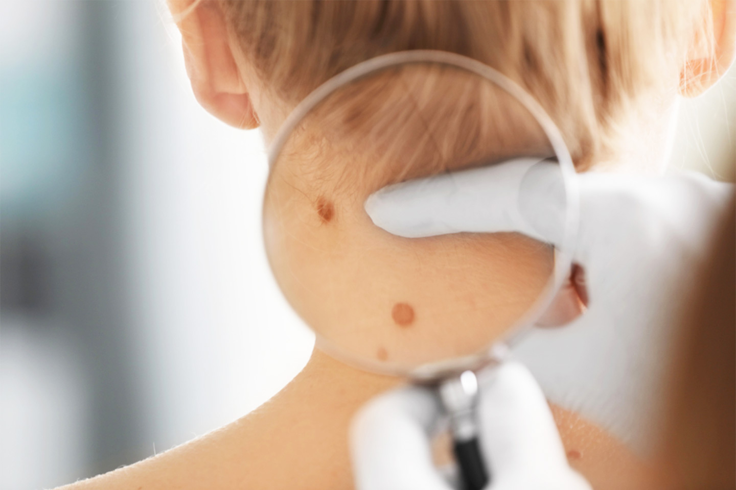 Ta bort pigmentfläckar, fibrom eller vårtor på Kungsholmen