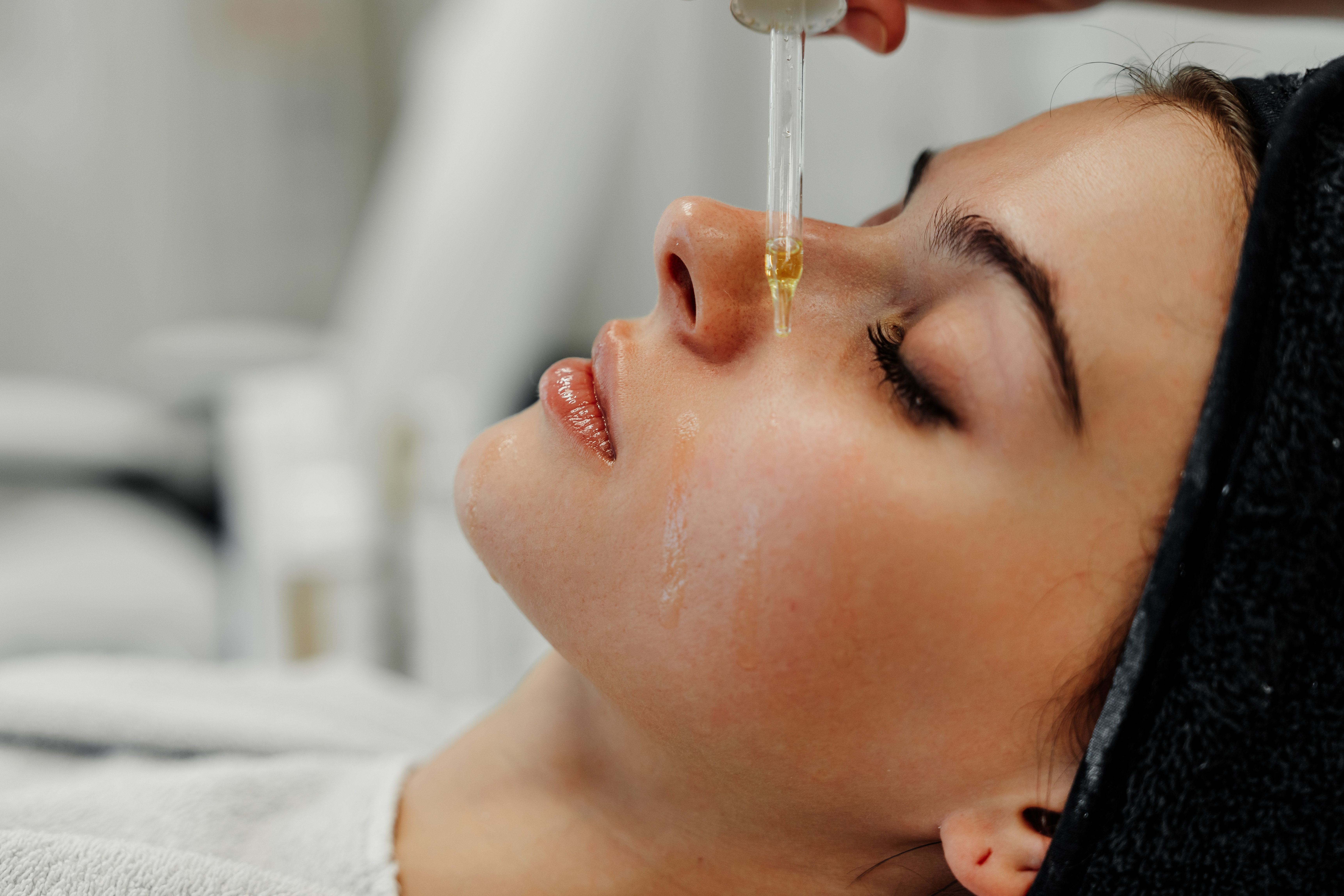 BioRePeel med microneedling hos DonMed Clinic i Johanneberg